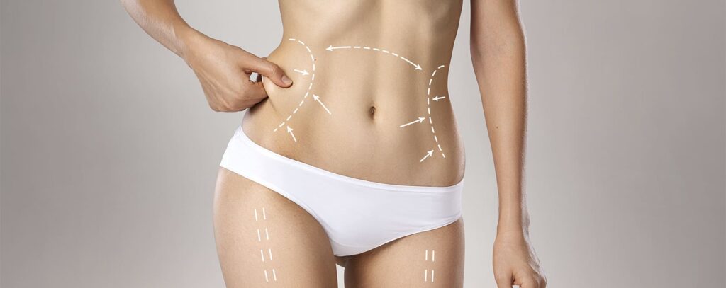 Abdominoplastia