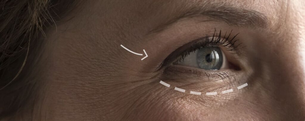 Blefaroplastia