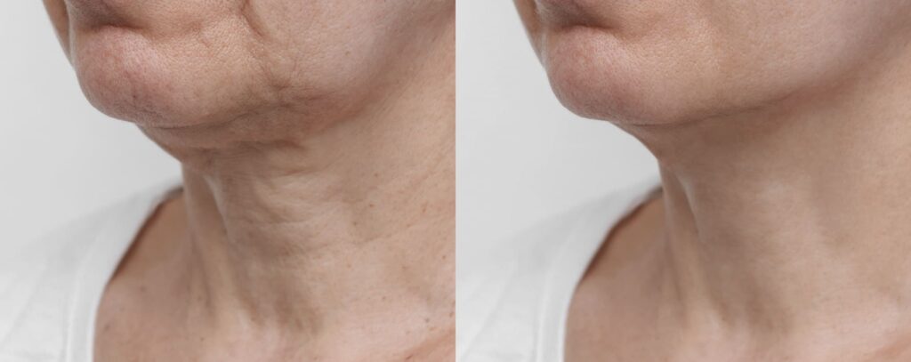 Cervicoplastia