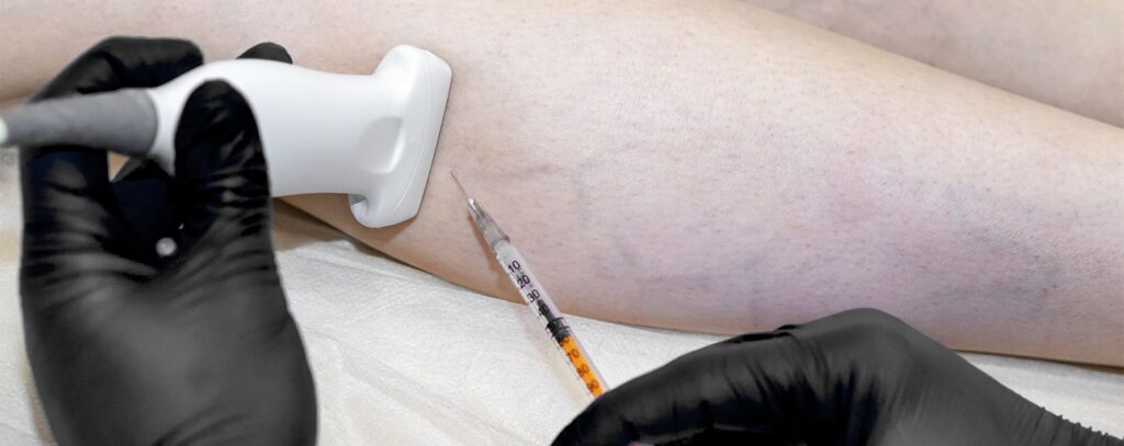 Escleroterapia líquida