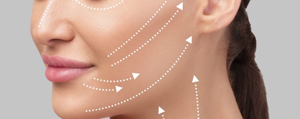 Facelift