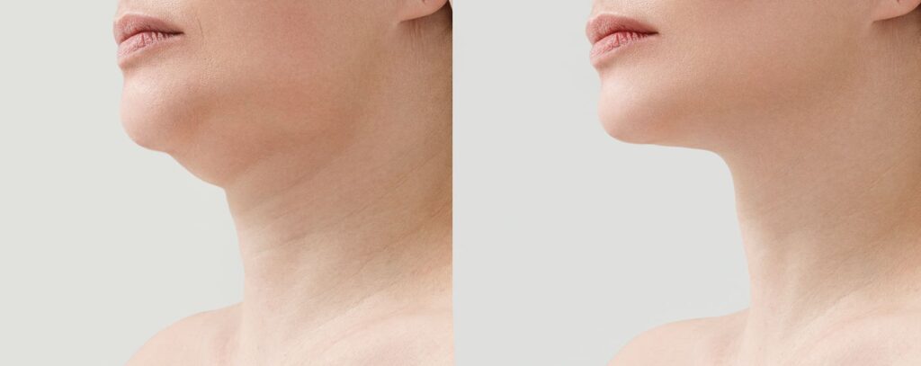 Mentoplastia