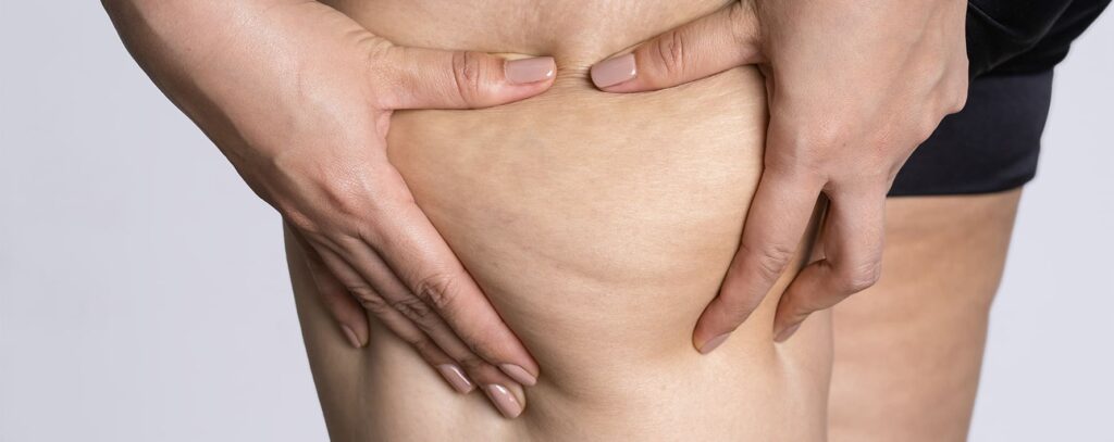 Tratamento de lipedema